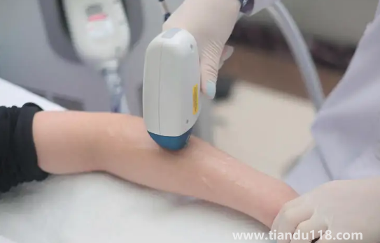 冰點脫毛的具體價格是多少錢(冰點脫毛一次能維持多久)(圖1) 冰點脫毛的具體價格是多少錢1