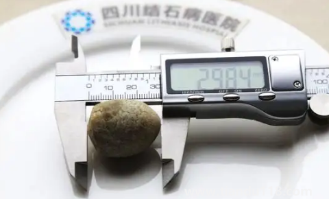 腎結(jié)石3mm需要吃藥嗎(3mm的腎結(jié)石會尿血嗎)(圖2) 腎結(jié)石3mm需要吃藥嗎2