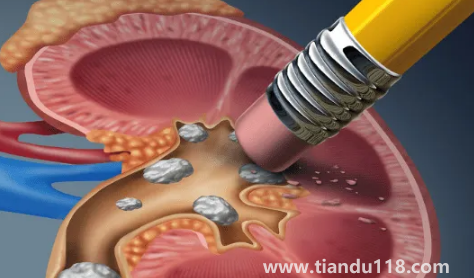 腎結(jié)石3mm需要吃藥嗎(3mm的腎結(jié)石會尿血嗎)(圖3) 腎結(jié)石3mm需要吃藥嗎3